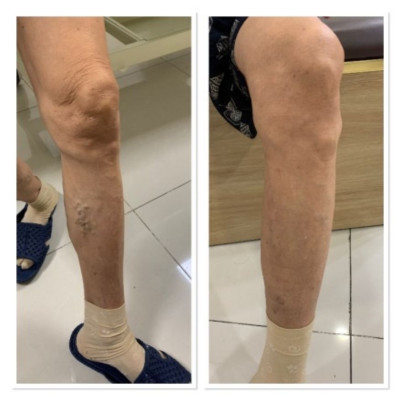 Máy nén ép trị liệu suy giãn tĩnh mạch chân Kachi MK394 - Hàng chính hãng