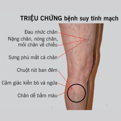 Máy nén ép trị liệu suy giãn tĩnh mạch chân Kachi MK394 - Hàng chính hãng