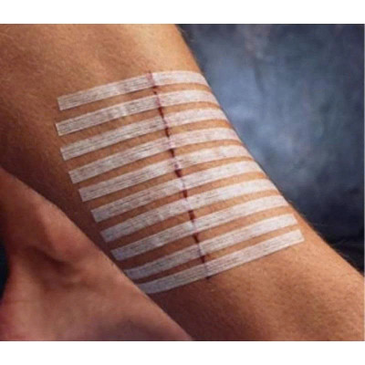 Miếng dán thay chỉ khâu da Steri-Strip R1546  6mm x 100mm (1/4IN x 4IN)