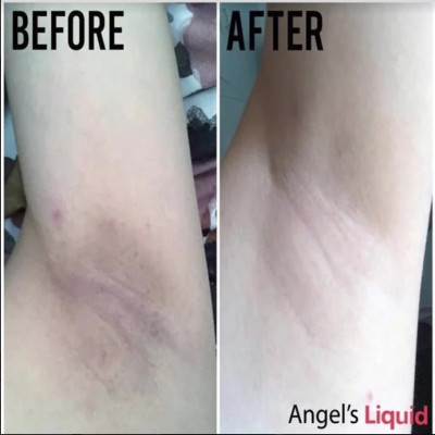Lăn Nách Mờ Thâm, Dưỡng Trắng Da Angel